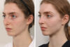 Rhinoplasty case #3992 slider thumbnail