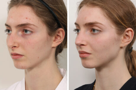 Rhinoplasty case #3992