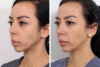 Rhinoplasty case #4013 slider thumbnail