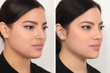 Rhinoplasty case #4019
