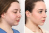 Rhinoplasty case #4023 slider thumbnail