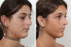 Rhinoplasty case #4036 slider thumbnail