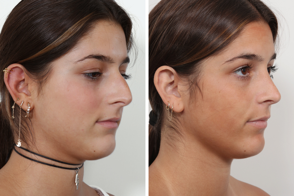 Rhinoplasty case #4036