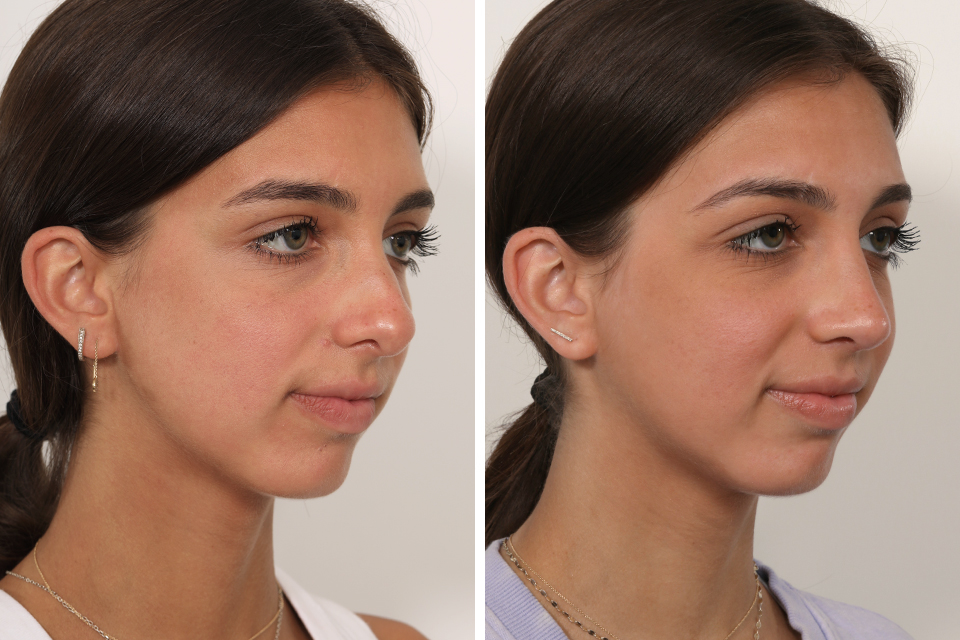 Rhinoplasty case #4058
