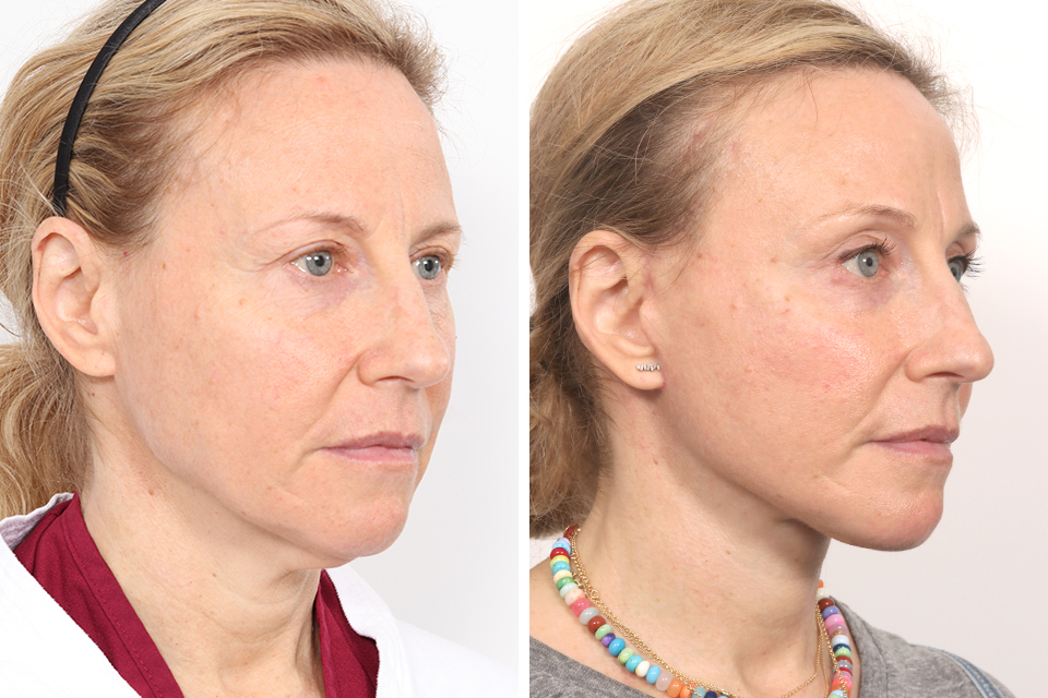 Blepharoplasty case #3766