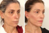 Rhinoplasty case #4029 slider thumbnail