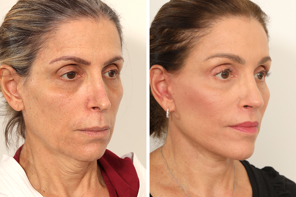 Rhinoplasty case #4029