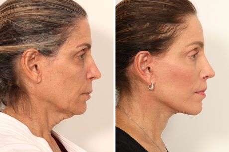Rhinoplasty case #4029