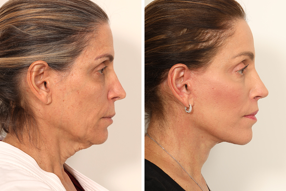 Rhinoplasty case #4029