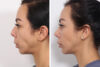 Rhinoplasty case #4013 slider thumbnail