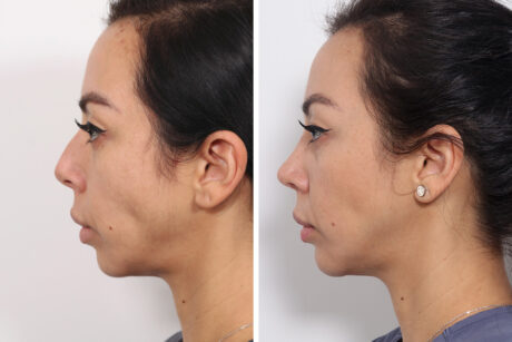 Rhinoplasty case #4013