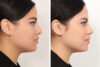 Rhinoplasty case #4019 slider thumbnail