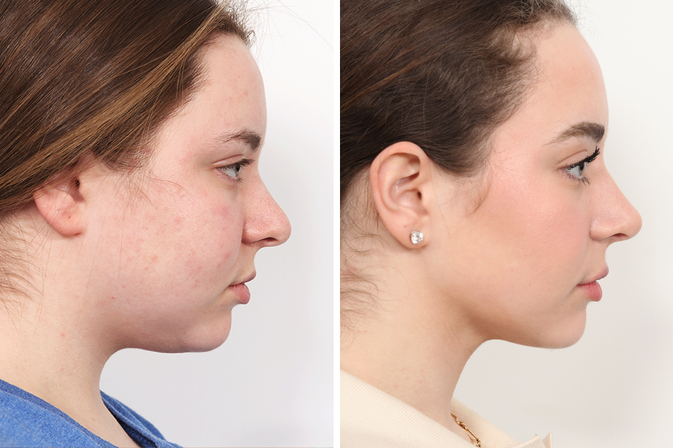 Rhinoplasty case #4023