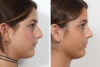 Rhinoplasty case #4036 slider thumbnail