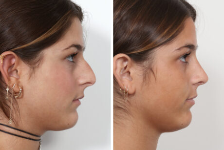 Rhinoplasty case #4036