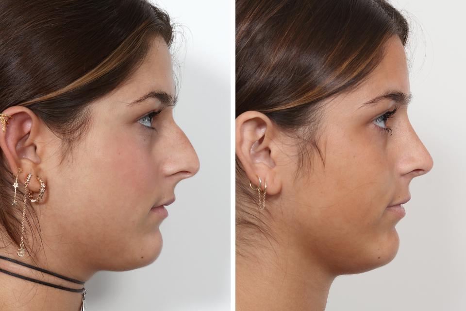 Rhinoplasty case #4036