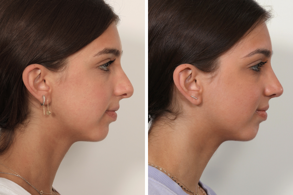 Rhinoplasty case #4058
