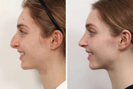 Rhinoplasty case #3992
