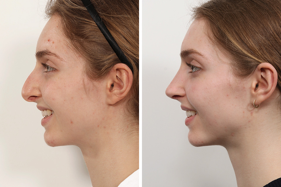 Rhinoplasty case #3992