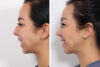 Rhinoplasty case #4013 slider thumbnail