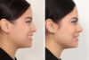 Rhinoplasty case #4019 slider thumbnail