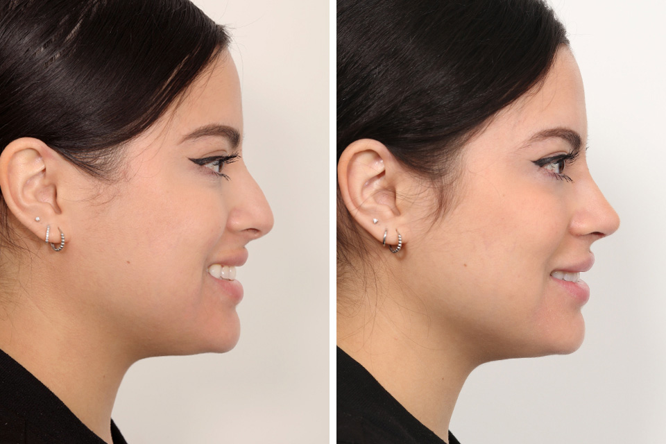Rhinoplasty case #4019