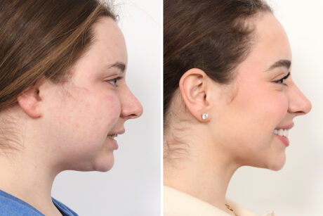Rhinoplasty case #4023