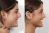 Rhinoplasty case #4036 slider thumbnail