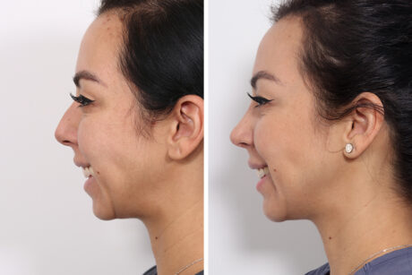 Rhinoplasty case #4013