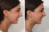 Rhinoplasty case #4058 slider thumbnail
