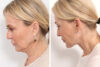 Blepharoplasty case #3546 slider thumbnail