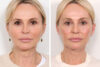 Blepharoplasty case #3546 slider thumbnail