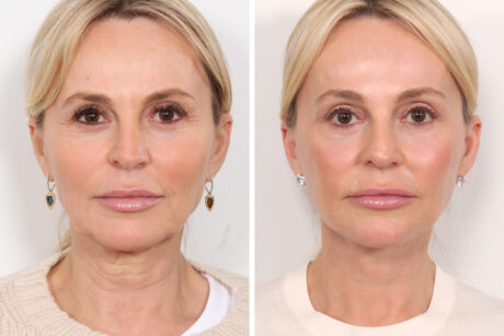 Blepharoplasty case #3546