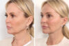 Blepharoplasty case #3546 slider thumbnail