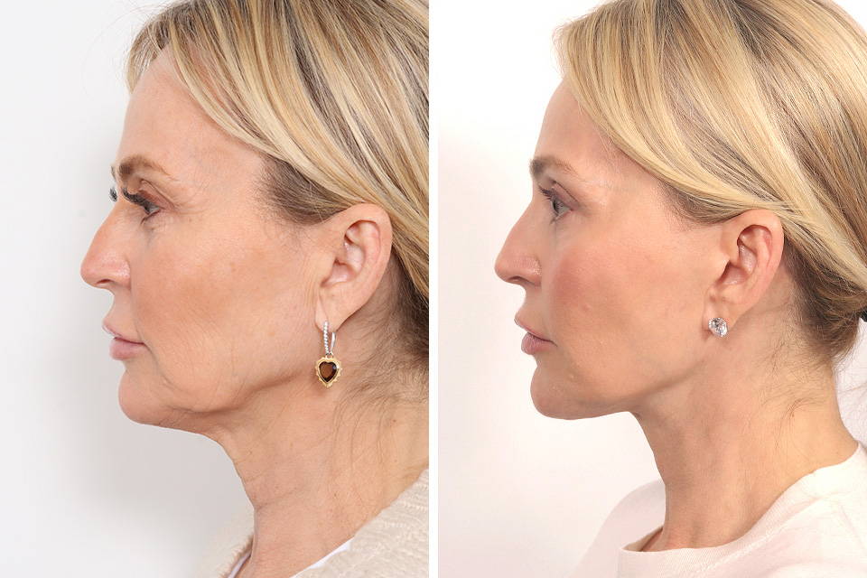 Blepharoplasty case #3546