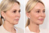 Blepharoplasty case #3546 slider thumbnail