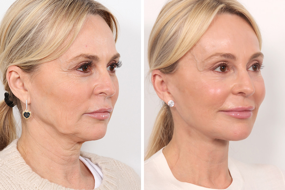 Blepharoplasty case #3546