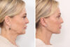 Blepharoplasty case #3546 slider thumbnail