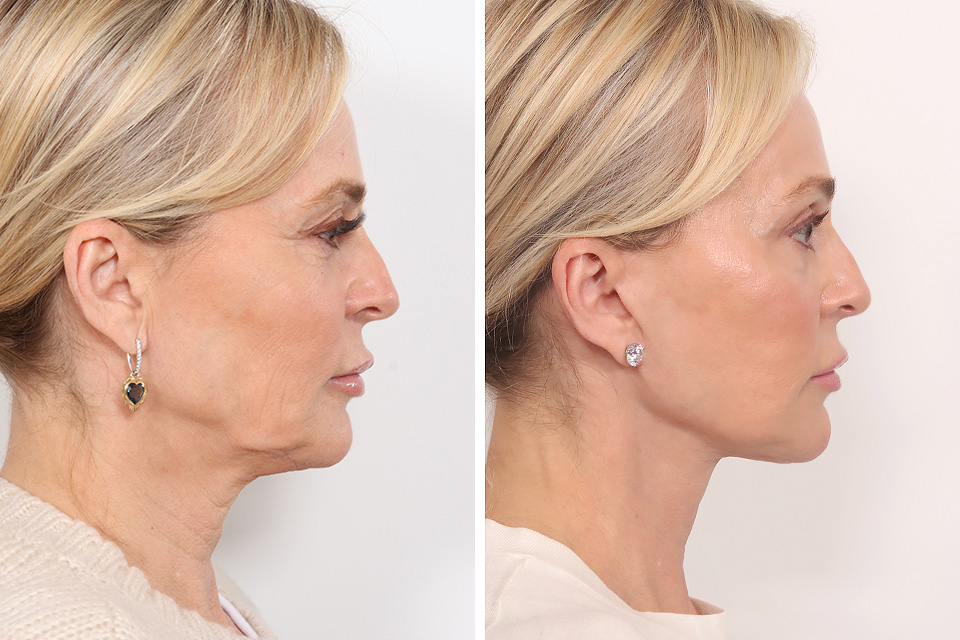 Blepharoplasty case #3546