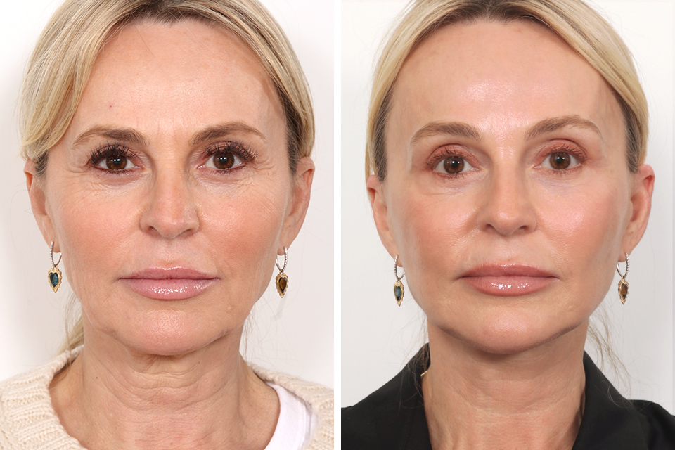 Facelift case #3760