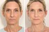 Rhinoplasty case #4003 slider thumbnail