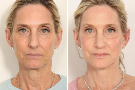Rhinoplasty case #4003
