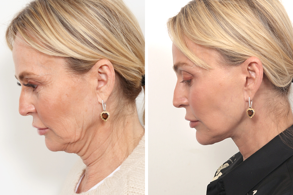 Facelift case #3760