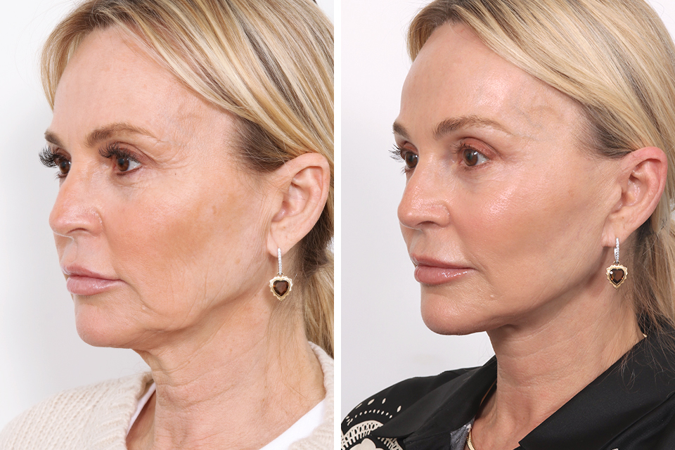 Facelift case #3760