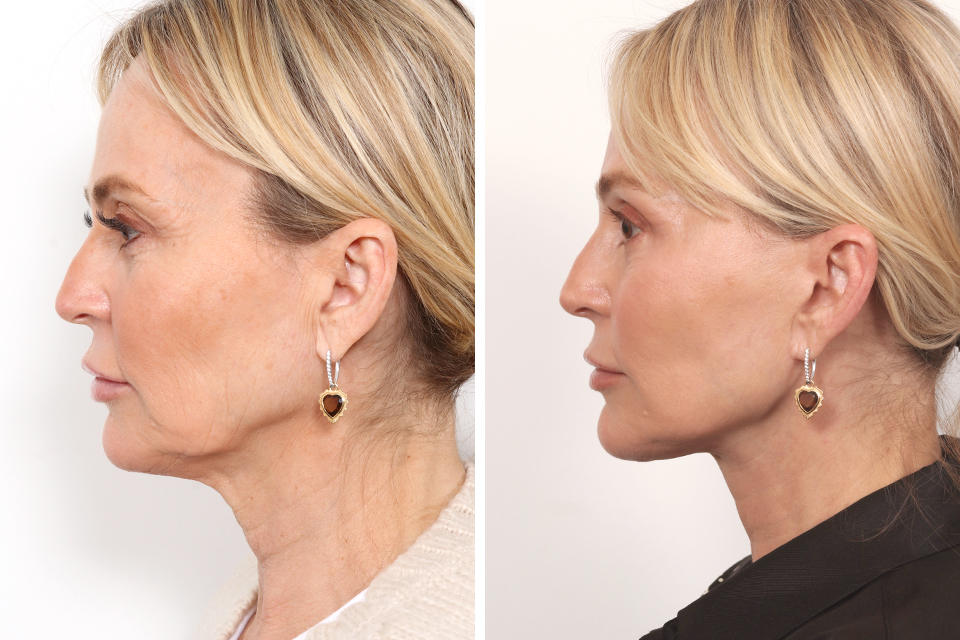 Facelift case #3760