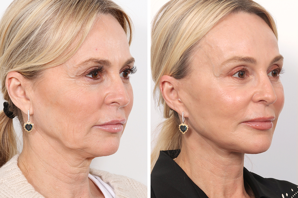 Facelift case #3760