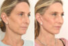 Rhinoplasty case #4003 slider thumbnail