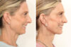 Rhinoplasty case #4003 slider thumbnail