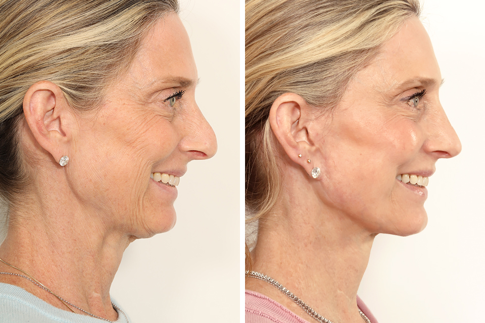 Rhinoplasty case #4003