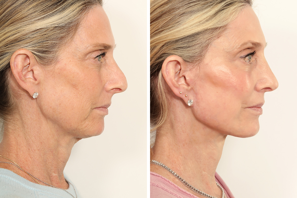 Rhinoplasty case #4003